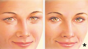 Eyelid Lift - Before & After Artist Example - eyelid surgery albany ny