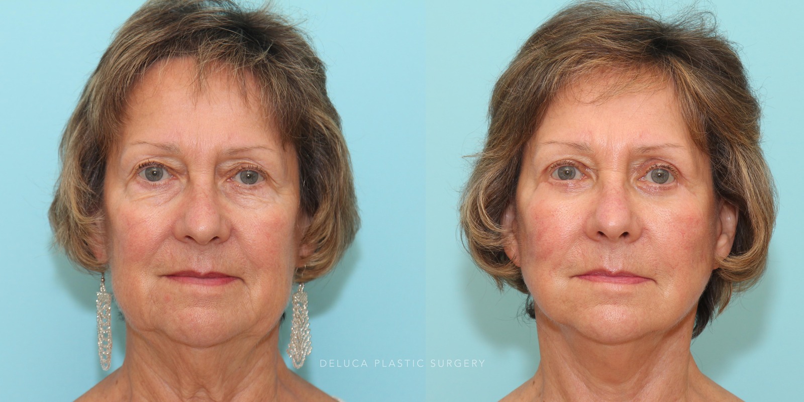 71 y/o Face and Neck Lift Blepharoplasty Fat Grafting to the Cheeks