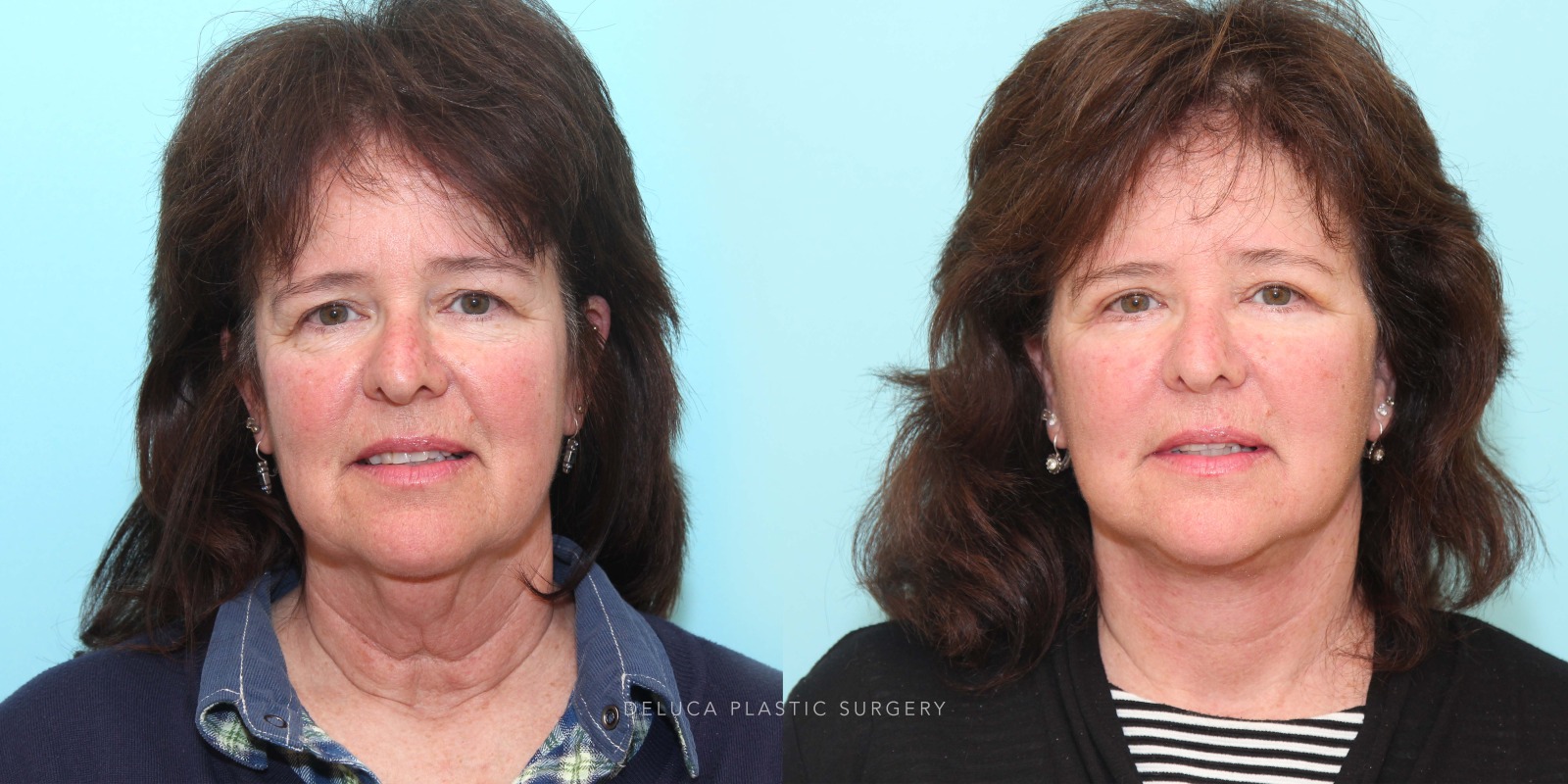 57 y/o Modified Face and Neck Lift and Upper and Lower Blepharoplasty