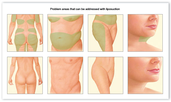 Liposuction treatment areas