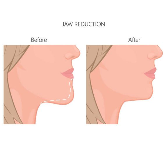 Illustration of a woman before and after jaw reduction surgery