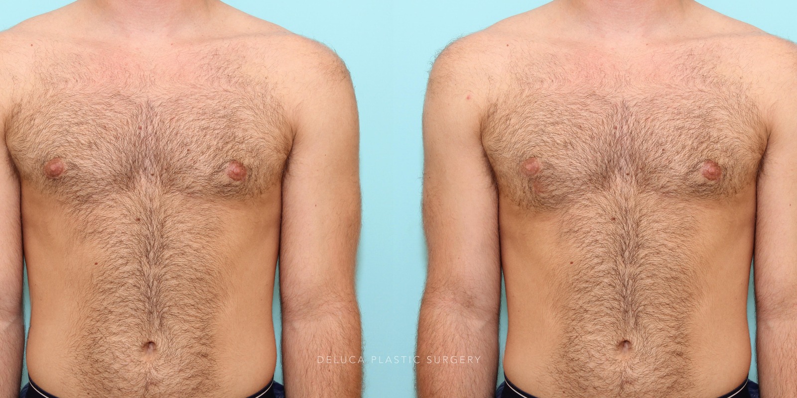 21 year old Correction of Gynecomastia Using Liposuction and Subcutaneous Mastectomy