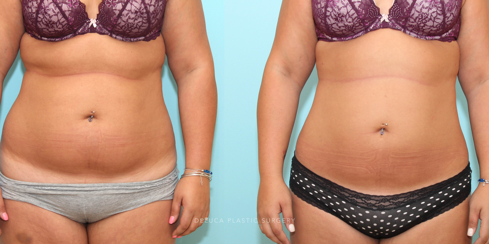 26 y/o Liposuction of The Abdomen