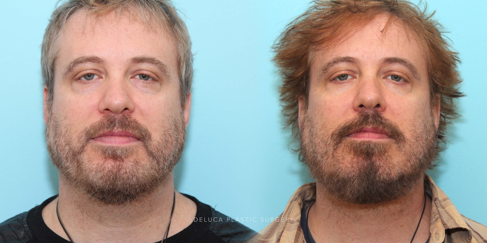 51 y/o Lower Eyelid Blepharoplasty with Fat Redraping