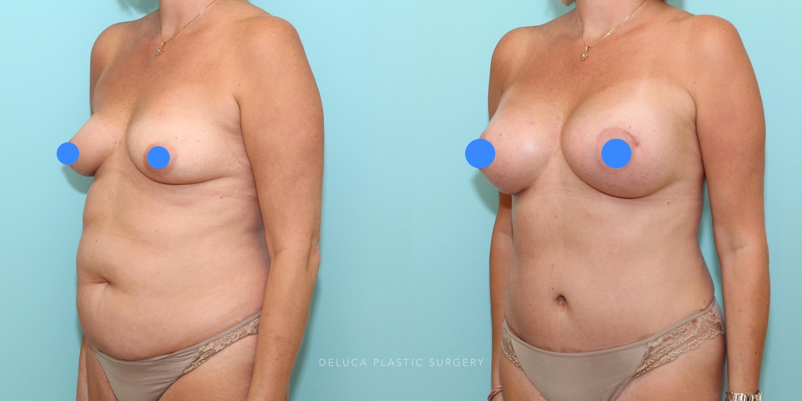Body procedure before and after