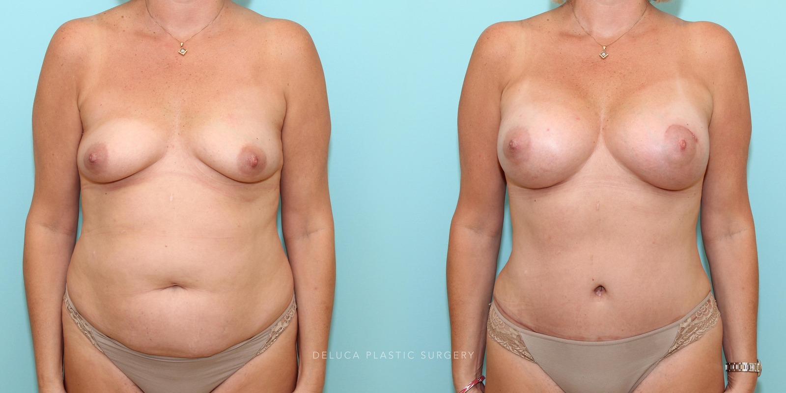 Mommy makeover in a tall woman after four children