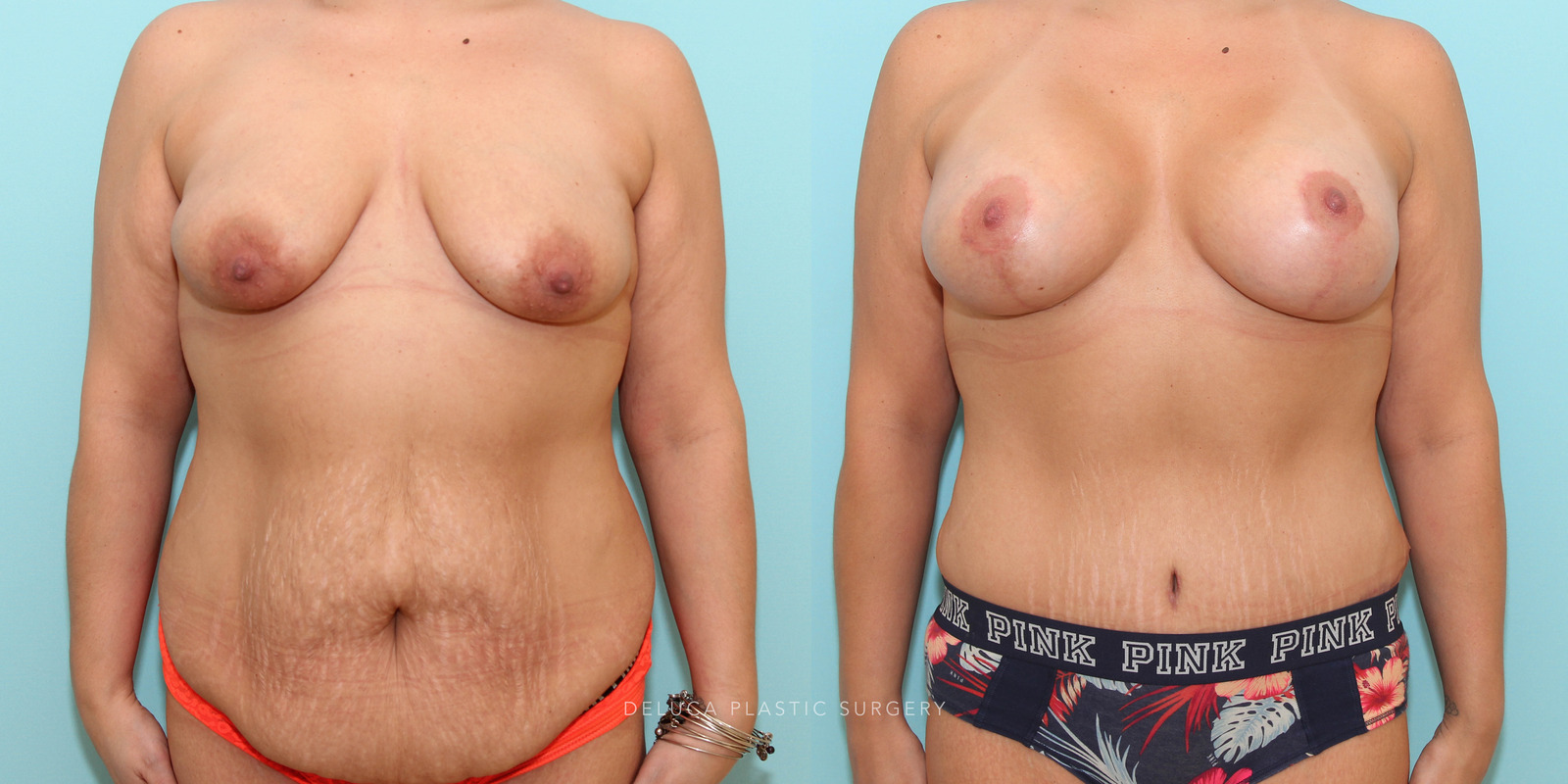 Mommy makeover in a young women