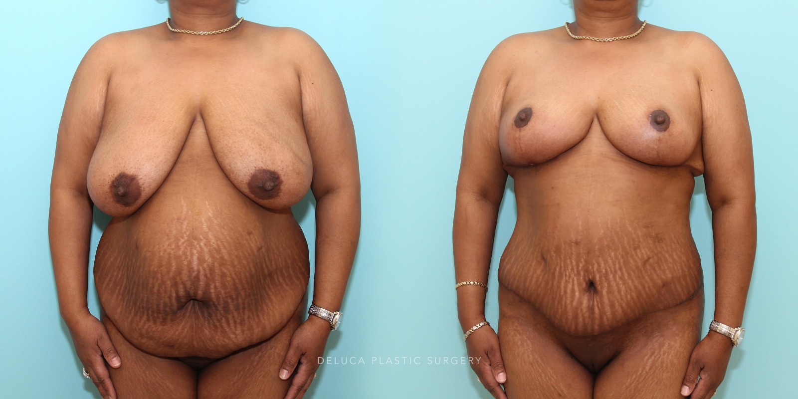 53 y/o Tummy Tuck and Inferior Pedicle Short Scar Wise Pattern Reduction