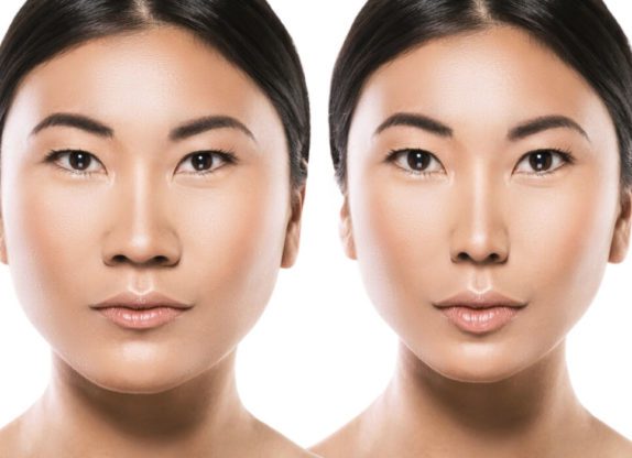 Before and after Orthognathic Surgery 