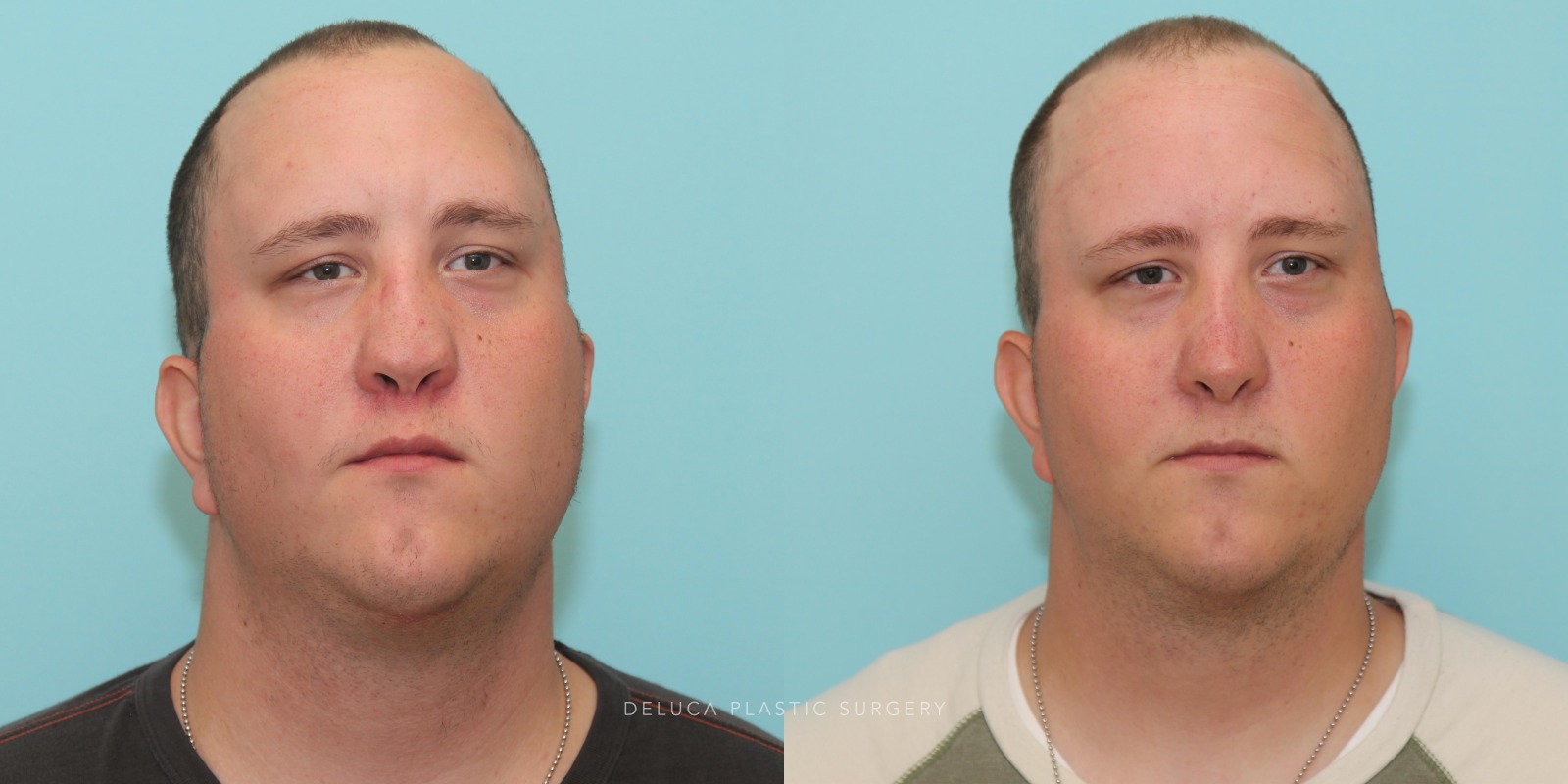 24 y/o Reconstructive Rhinoplasty Using Rib Graft