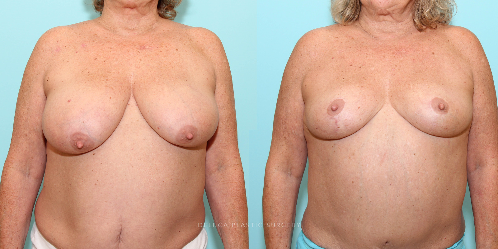 62 y/o Superior Pedicle Short Scar Wise Skin Pattern Breast Reduction