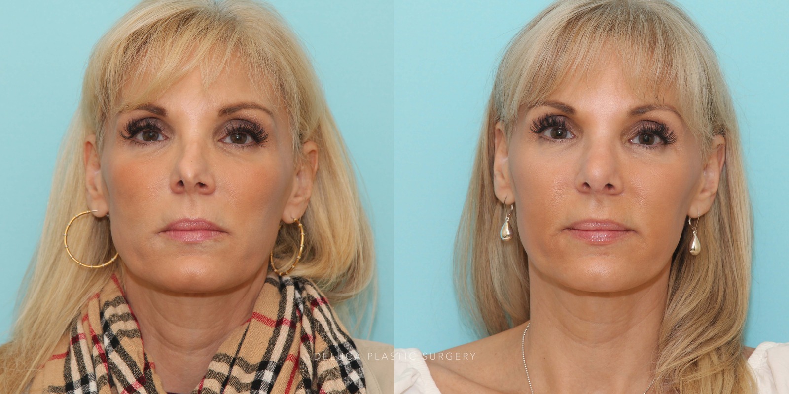 51 y/o Secondary Rhinoplasty Using Rib Graft