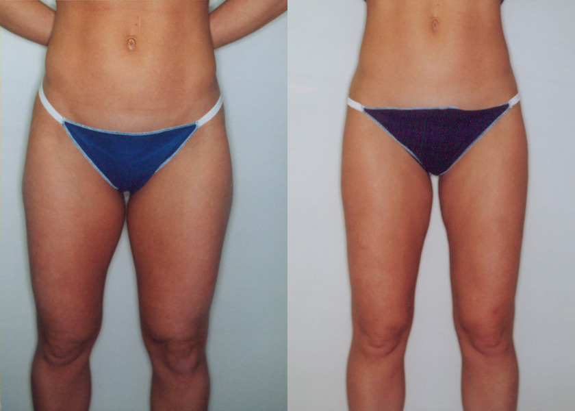 Liposuction (Thighs, Knees & Buttocks)