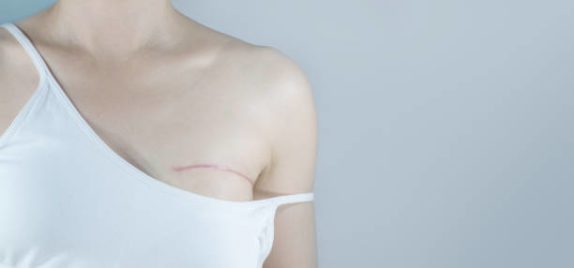 a ftm transgender top surgery patient post-op showing operative scars