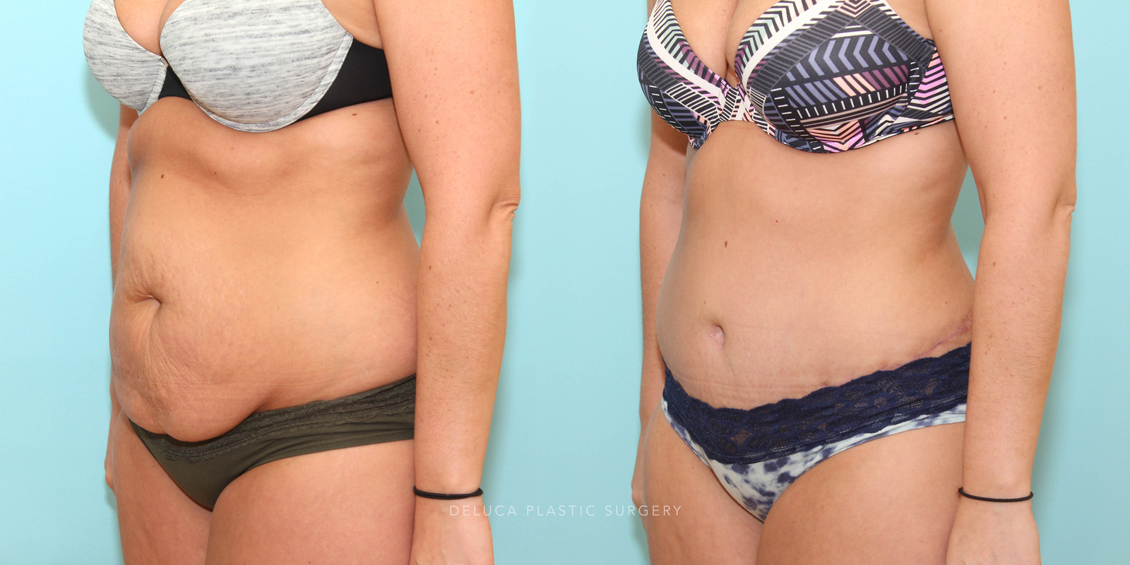 Body contouring before and after result