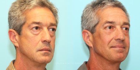 upper+and+lower+eyelid+surgery+with+fat+re-draping+and+facial+implants+for+mid-face+hollowing_4