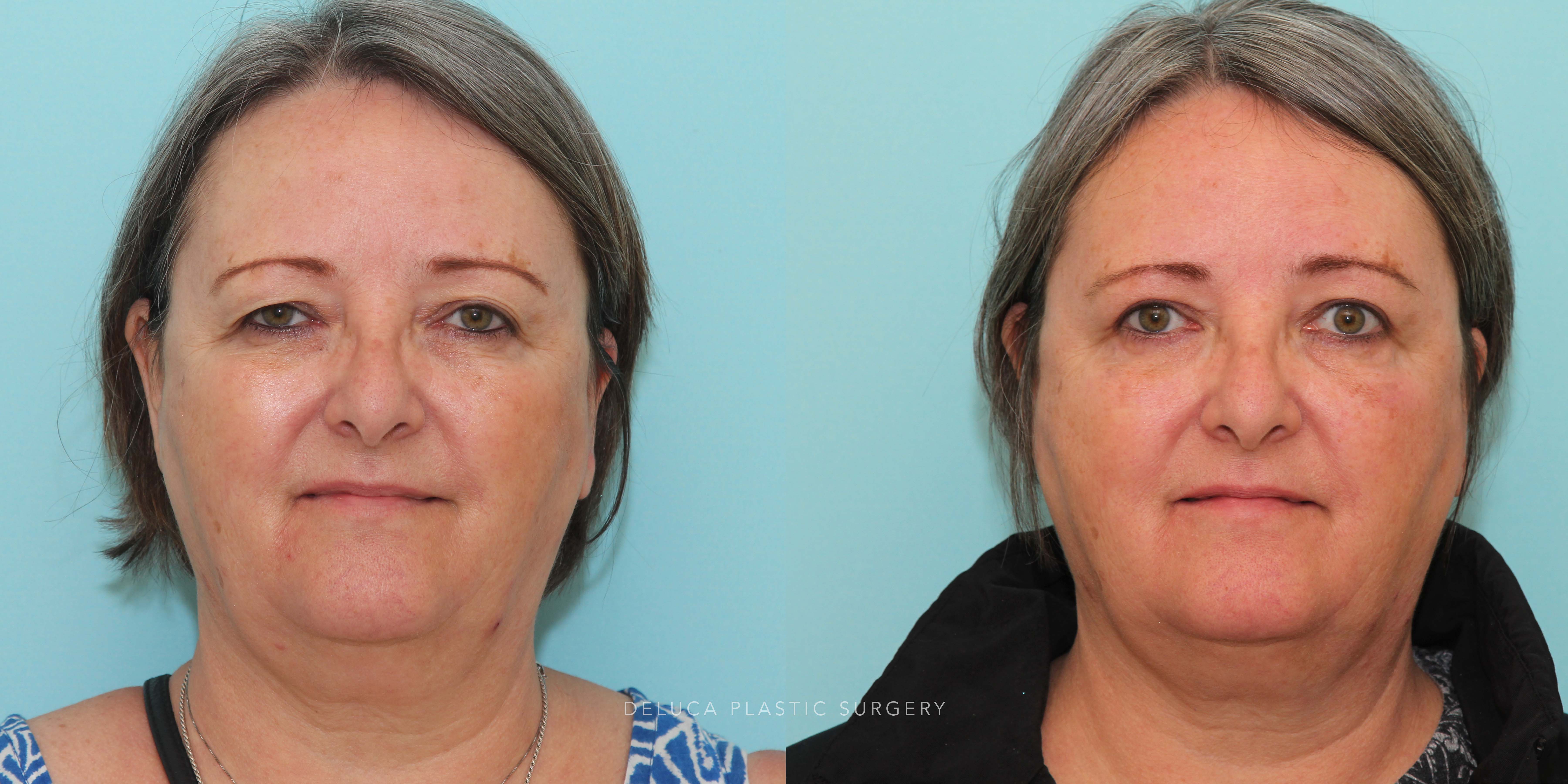 63 y/o Upper Eyelid Blepharoplasty